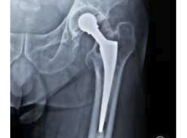 Uncovering the Best Hip Replacement Lawsuit Lawyer in Aurora with this Sneaky Scheme!