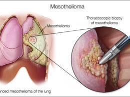 Discovering the Best Budget Mesothelioma Class Action Law Firm in Salem: A Step-by-Step Guide